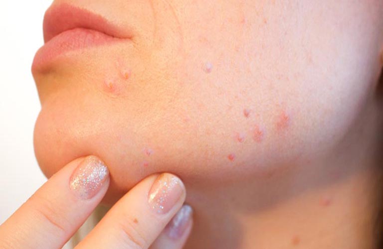 acne-cure image